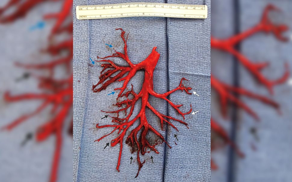 giant-blood-clot-in-the-shape-of-the-lung-s-branched-airway-medihelp