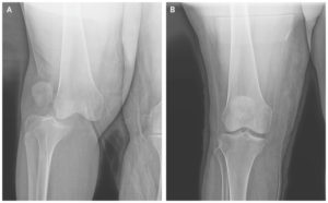 Lateral knee discloation