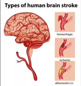 Types of human brain stroke