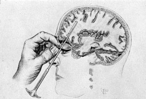 History of lobotomies