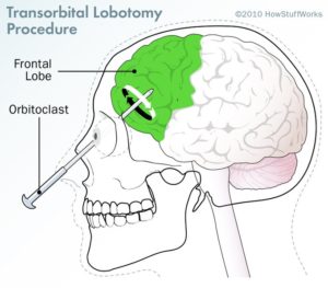 History Of Lobotomies Medihelp