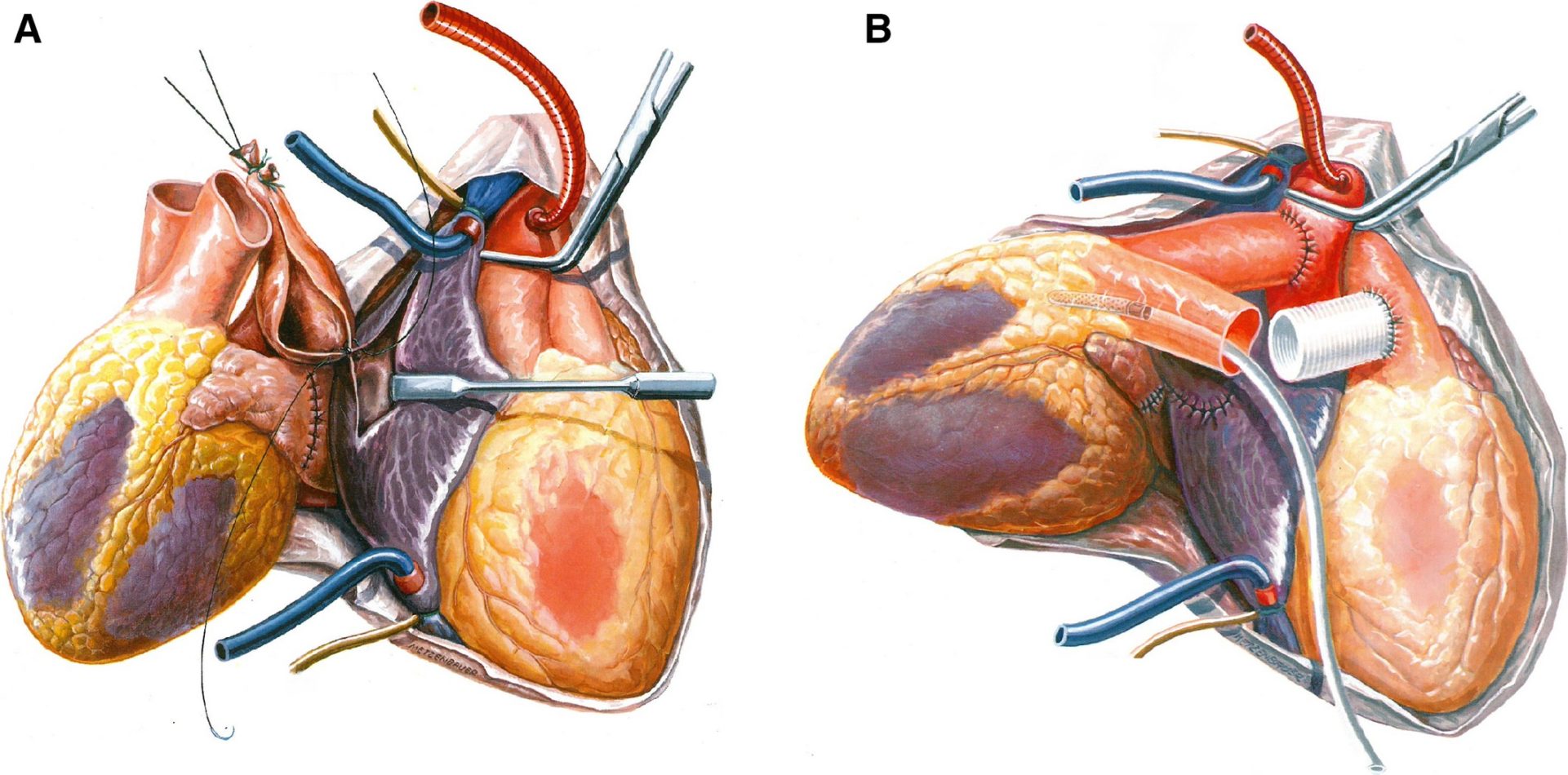 Heterotopic heart transplant