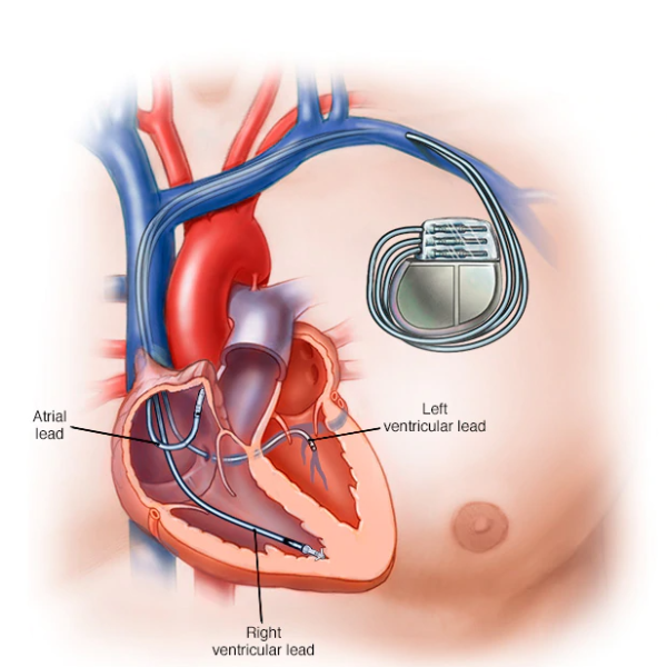 The Accidental Invention of the Lifesaving Pacemaker