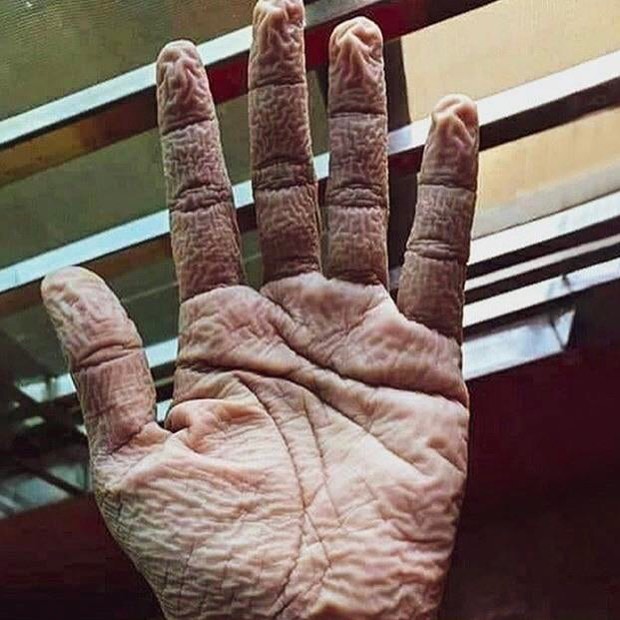 The hand of a doctor after removing his medical precautionary suit and gloves after 10 hours of duty.