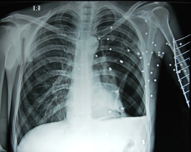 Anticoagulant-induced priapism progressing to penile gangrene: a devastating complication!