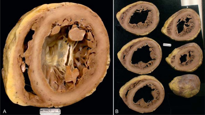 dilated-cardiomyopathy-medihelp