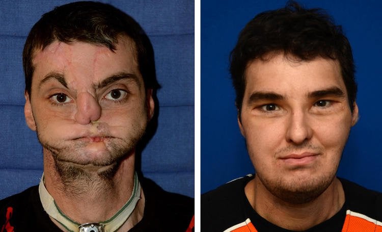 Facial transplantation after a shotgun accident