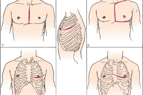 Emergency department thoracotomy for the critically injured patient: Objectives, indications, and outcomes