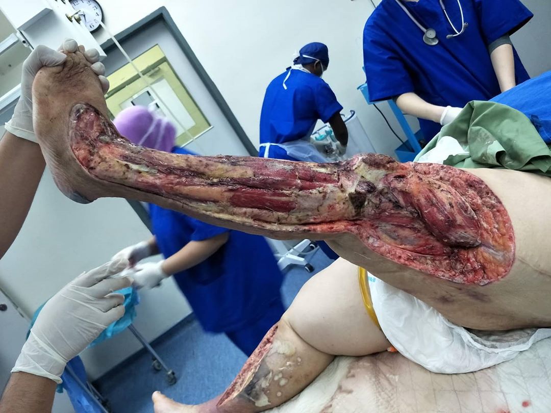 Case of billateral necrotizing fasciitis post debridement surgery