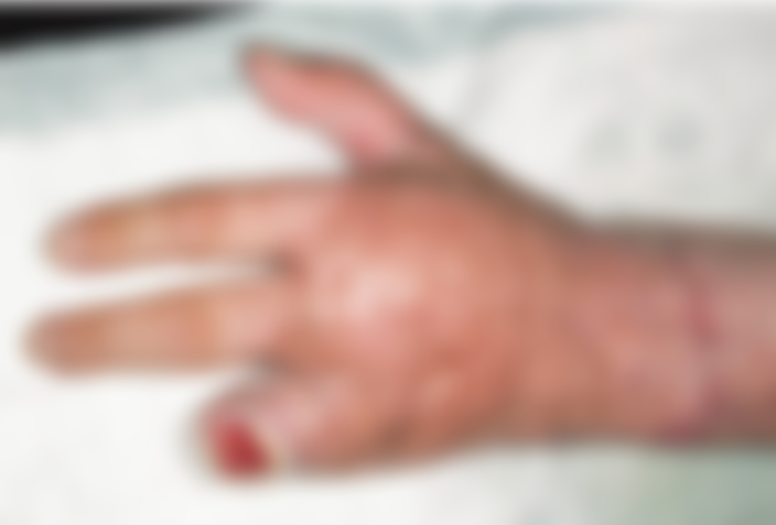 Degloving Injuries Of Upper Extremity MediHelp