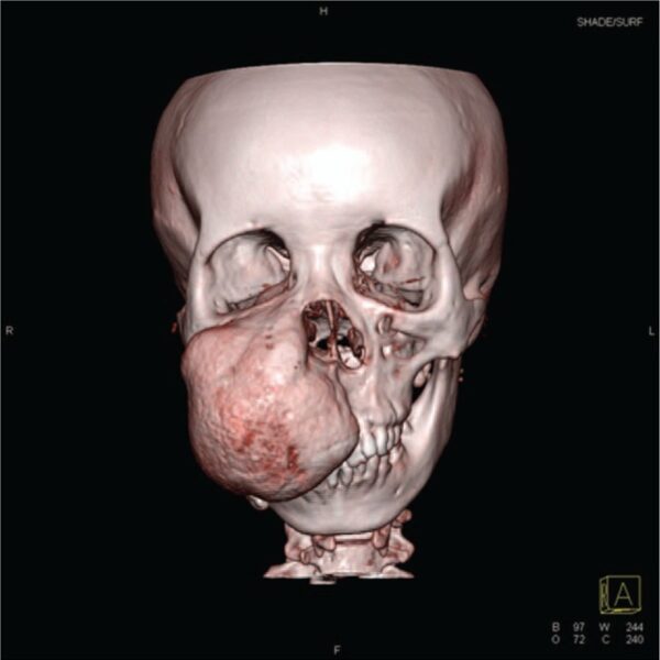 Surgical correction of residual facial deformity following conservative excision of a giant maxillary ossifying fibroma