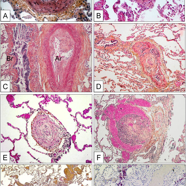 Pulmonary arterial hypertension