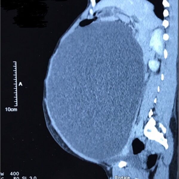 Diagnosis and management of a giant ovarian cyst in the gravid-puerperium period: a case report