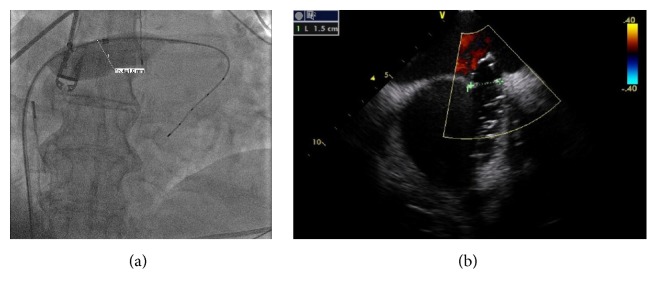 Successful Percutaneous Retrieval of Embolized Septal Occluder Device from Aortic Arch and Placement of a Newer Septal Occluder Device in Combined Procedure