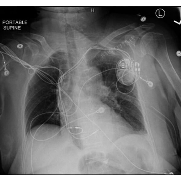 Subacute Right Ventricular Perforation by Pacemaker Lead Causing Left-Sided Hemothorax and Epicardial Hematoma