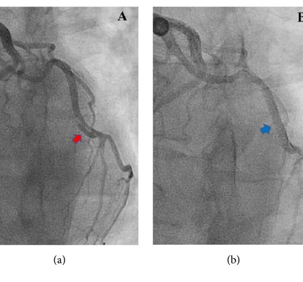 Spontaneous Coronary Artery Dissection: A Rare Manifestation of Alport Syndrome