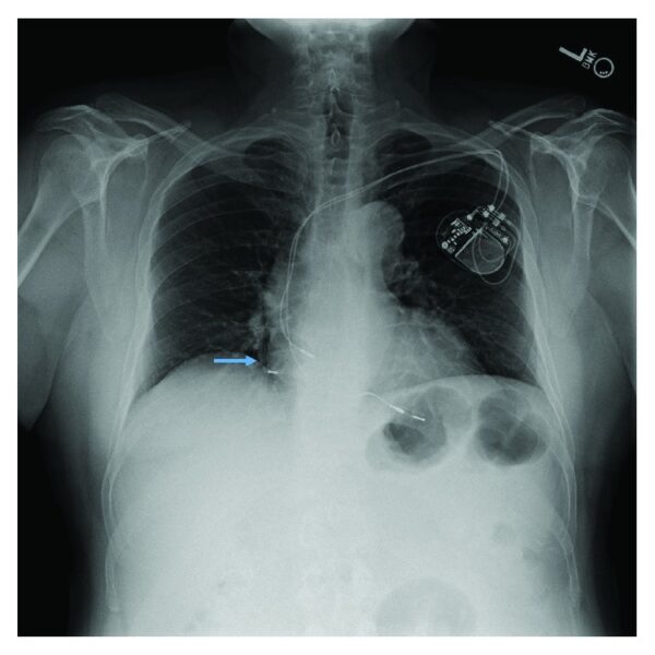 A Rare Case of Complete Fragmentation of Pacemaker Lead after a High-Velocity Theme Park Ride