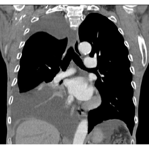 A Large Pleural Effusion following Abdominal Aortic Surgery