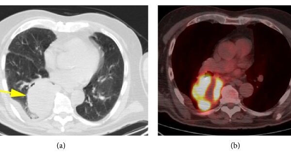 Primary Pulmonary Malignant Fibrous Histiocytoma