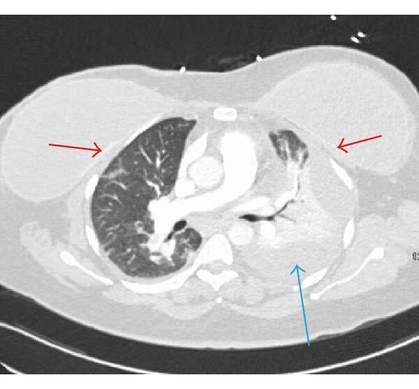 Silicone Breast Implants: A Rare Cause of Pleural Effusion