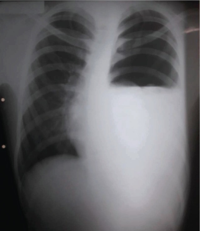 Spontaneous Hemopneumothorax: A Rare Cause of Unexplained Hemodynamic Instability in a Young Patient