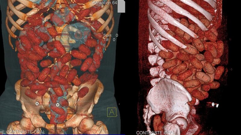 X-ray of digestive tract, revealing 72 cocaine stuffed bags