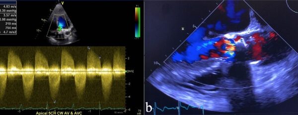 Early Structural Deterioration of a Sutureless Bioprosthetic Aortic Valve