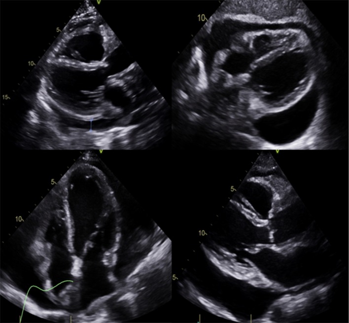 Erdheim-Chester Disease With Extensive Pericardial Involvement: A Case Report and Systematic Review