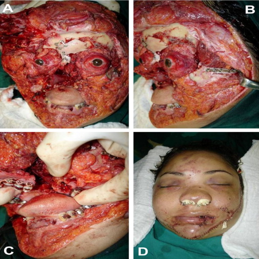 An impressive case of complete traumatic maxillofacial degloving.