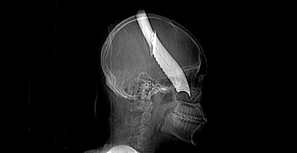 Impalement head injury with serrated meat knife.