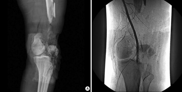 Reconstructive Knee Surgery