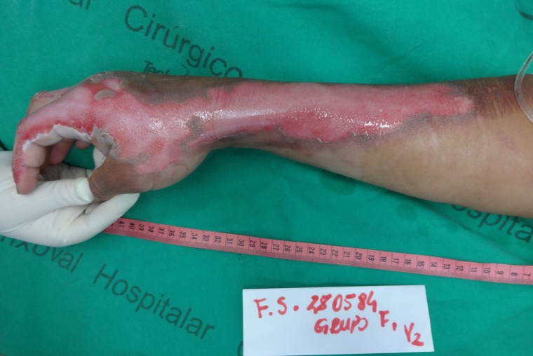 Innovative treatment using tilapia skin as a xenograft for partial thickness burns after a gunpowder explosion