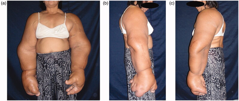 A patient with macrodystrophia lipomatosa bilaterally affecting the entire upper extremity: reporting of a rare case and literature review