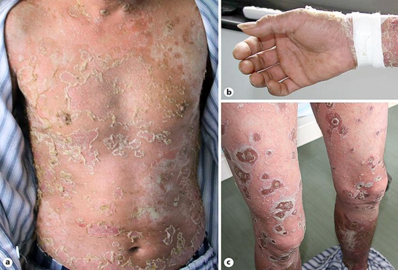 A Case of Ceftriaxone-Induced Acute Generalized Exanthematous Pustulosis/Generalized Pustular Psoriasis Overlap