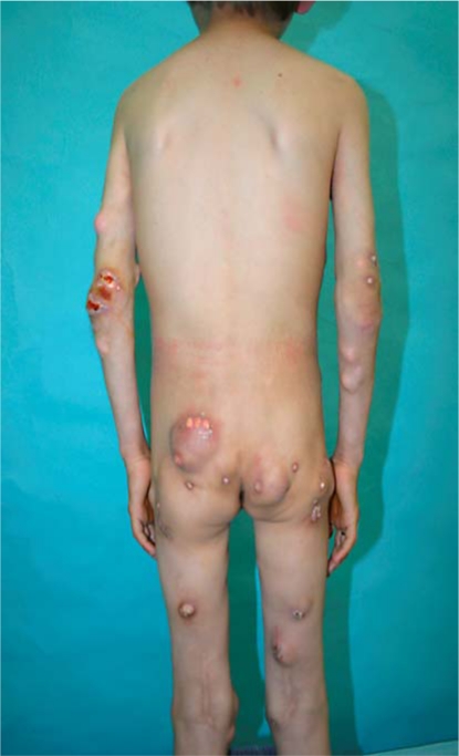 Unusual Idiopathic Calcinosis Cutis Universalis in a Child