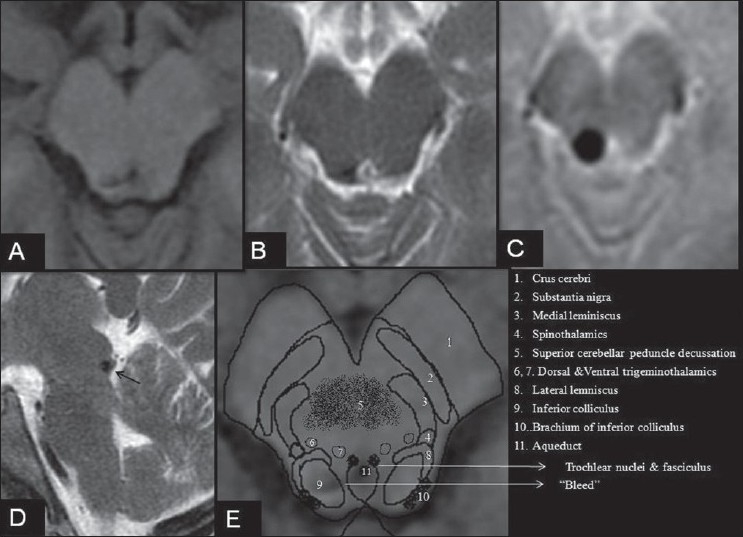 Isolated trochlear nerve palsy with midbrain hemorrhage
