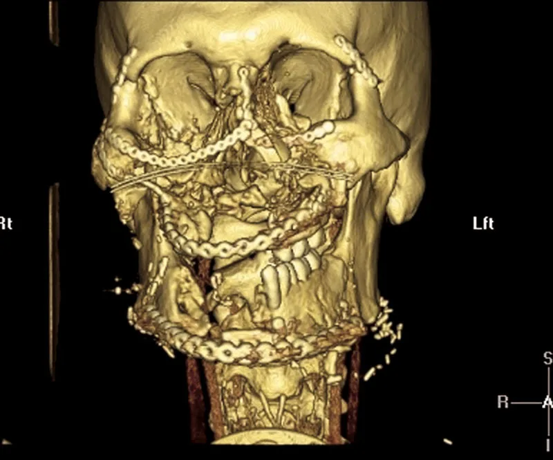 Should We Consider Preparing Patients for Future Face Transplant when Managing Complex Facial Trauma?